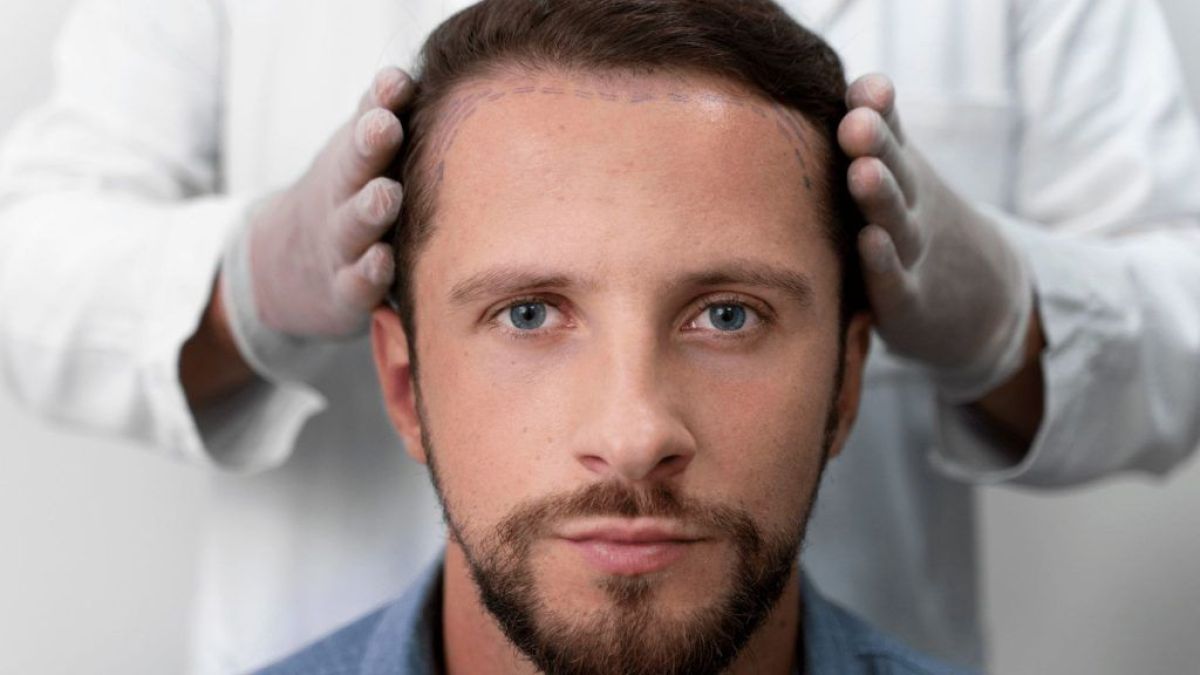 Errores médicos en injertos capilares: vías legales