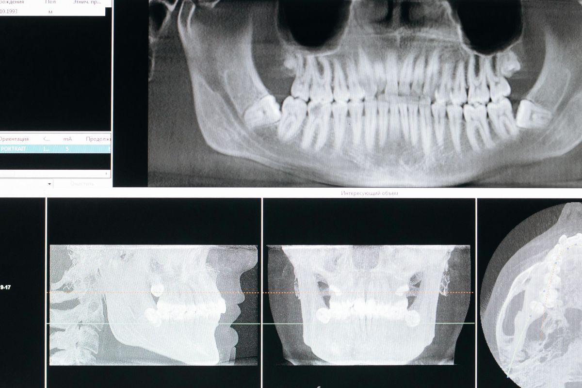 Errores médicos en tratamientos con prótesis dentales