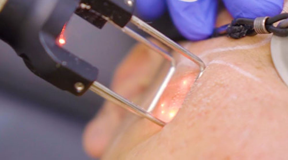 Reclamaciones por mala praxis en depilación láser